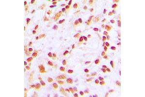 Immunohistochemical analysis of CBP (AcK1535) staining in human lung cancer formalin fixed paraffin embedded tissue section. (CBP antibody  (acLys1535))