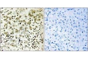 Immunohistochemistry analysis of paraffin-embedded human breast carcinoma tissue, using CTDSP1 Antibody. (CTDSP1 antibody  (AA 1-50))