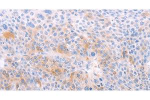 Immunohistochemistry of paraffin-embedded Human liver cancer using EDG6 Polyclonal Antibody at dilution of 1:40 (S1PR4 antibody)