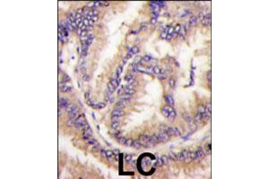 Formalin-fixed and paraffin-embedded human lung carcinoma tissue reacted with CDKL5 polyclonal antibody  , which was peroxidase-conjugated to the secondary antibody, followed by DAB staining.