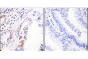 Immunohistochemistry analysis of paraffin-embedded human lung carcinoma tissue, using AML1 (Ab-303) Antibody. (RUNX1 antibody  (AA 269-318))