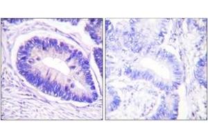 Immunohistochemistry analysis of paraffin-embedded human colon carcinoma, using MYPT1 (Phospho-Thr853) Antibody. (PPP1R12A antibody  (pThr853))