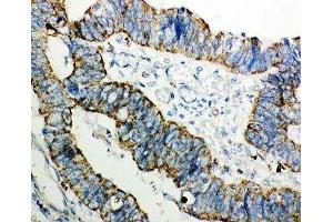 IHC-P: PRDX3 antibody testing of human intestinal cancer tissue (Peroxiredoxin 3 antibody  (AA 110-256))