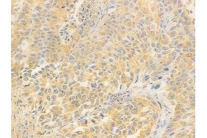 ABIN7095803 and ABIN7099865 at 1/100 staining human lung squamous cell carcinoma by IHC-P.