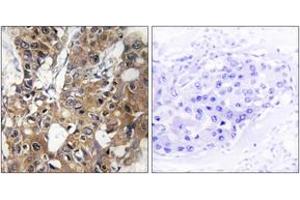 Immunohistochemistry analysis of paraffin-embedded human breast carcinoma tissue, using CD9 Antibody. (CD9 antibody  (AA 101-150))