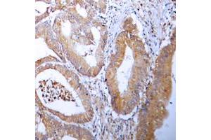 Immunohistochemical analysis of ACC alpha staining in human colon cancer formalin fixed paraffin embedded tissue section. (Acetyl-CoA Carboxylase alpha antibody  (N-Term))