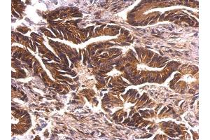 IHC-P Image PRK2 antibody [N1N3] detects PRK2 protein at cytosol on human colon carcinoma by immunohistochemical analysis. (PKN2 antibody)