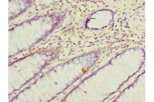 Immunohistochemistry of paraffin-embedded human colon cancer using ABIN7171111 at dilution of 1:100 (VAT1L antibody  (AA 1-419))