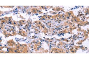 Immunohistochemistry of paraffin-embedded Human thyroid cancer using ESPL1 Polyclonal Antibody at dilution of 1:40 (Separase antibody)