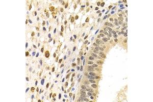 Immunohistochemistry of paraffin-embedded human uterine cancer using DNMT3A Antibody (ABIN5971621) at dilution of 1/100 (40x lens). (DNMT3A antibody)