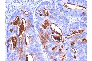 Formalin-fixed, paraffin-embedded human Colon Carcinoma stained with CA19-9 Monoclonal Antibody (SPM588). (CA 19-9 antibody)