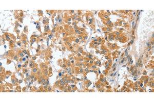 Immunohistochemistry of paraffin-embedded Human thyroid cancer tissue using CHMP4B Polyclonal Antibody at dilution 1:40 (CHMP4B antibody)