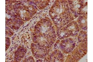 IHC image of ABIN7145754 diluted at 1:300 and staining in paraffin-embedded human colon cancer performed on a Leica BondTM system. (BAAT1 antibody  (AA 603-821))