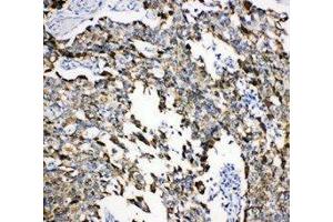 Anti-Grp75 antibody, IHC(P) IHC(P): Human Lung Cancer Tissue (HSPA9 antibody  (C-Term))