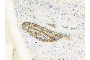 ABIN6260813 and ABIN6277925 at 1/100 staining human esophageal carcinoma by IHC-P.