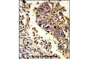 Formalin-fixed and paraffin-embedded human lung carcinoma reacted with LUC7L Antibody , which was peroxidase-conjugated to the secondary antibody, followed by DAB staining. (LUC7L antibody  (C-Term))