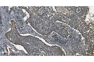 IHC analysis of MAP3K8 using anti-MAP3K8 antibody (ABIN4886663). (MAP3K8 antibody  (AA 9-193))