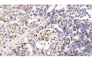 Detection of CXCR4 in Human Lung cancer Tissue using Polyclonal Antibody to Chemokine C-X-C-Motif Receptor 4 (CXCR4) (CXCR4 antibody  (AA 262-352))