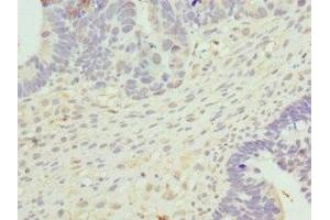 Immunohistochemistry of paraffin-embedded human ovarian cancer using ABIN7149288 at dilution of 1:100 (Cytohesin 2 antibody  (AA 150-350))