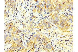 IHC image of ABIN7166908 diluted at 1:400 and staining in paraffin-embedded human pancreatic cancer performed on a Leica BondTM system. (PKM antibody  (AA 185-461))
