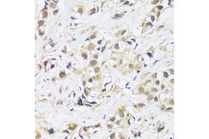 Immunohistochemistry of paraffin-embedded human breast cancer using  antibody (ABIN7265374) at dilution of 1:100 (40x lens). (ASCL4 antibody  (AA 1-172))