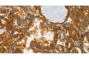 Immunohistochemistry of paraffin-embedded Human thyroid cancer using GOT1 Polyclonal Antibody at dilution of 1:50 (GOT1 antibody)