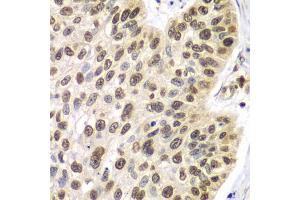Immunohistochemistry of paraffin-embedded human lung cancer using SEPT7 antibody. (Septin 7 antibody)