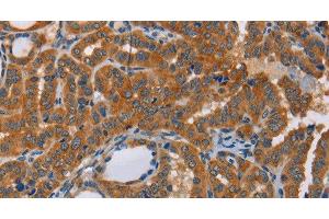 Immunohistochemistry of paraffin-embedded Human thyroid cancer tissue using CK-13 Polyclonal Antibody at dilution 1:50 (Cytokeratin 13 antibody)