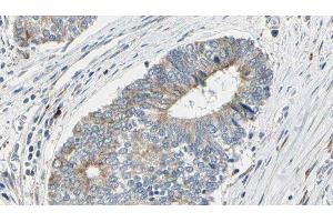 ABIN6277182 at 1/100 staining Human prostate tissue by IHC-P. (Dynamitin antibody  (C-Term))