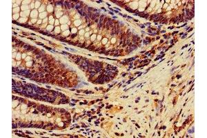 IHC image of ABIN7150205 diluted at 1:400 and staining in paraffin-embedded human colon cancer performed on a Leica BondTM system. (MSH2 antibody  (AA 2-254))