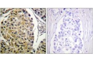 Immunohistochemistry analysis of paraffin-embedded human breast carcinoma, using PKC delta (Phospho-Tyr313) Antibody.