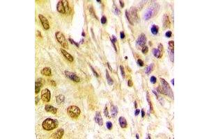 Immunohistochemical analysis of Histone H4 (AcK5) staining in human lung cancer formalin fixed paraffin embedded tissue section. (Histone H4 antibody  (acLys5, N-Term))