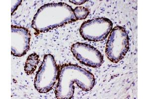 IHC-P: Arg2 antibody testing of human breast cancer tissue (ARG2 antibody  (N-Term))