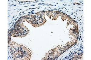 Immunohistochemical staining of paraffin-embedded Adenocarcinoma of colon tissue using anti-ARHGDIA mouse monoclonal antibody. (ARHGDIA antibody)