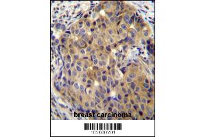 ST14 Antibody immunohistochemistry analysis in formalin fixed and paraffin embedded human breast carcinoma followed by peroxidase conjugation of the secondary antibody and DAB staining. (ST14 antibody  (C-Term))