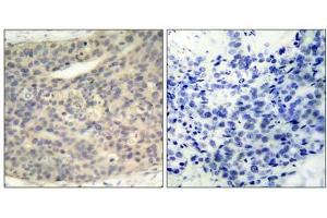 Immunohistochemical analysis of paraffin- embedded human breast carcinoma tissue, using LIMK1 (phospho- Thr508) antibody (E011126). (LIM Domain Kinase 1 antibody  (pThr508))
