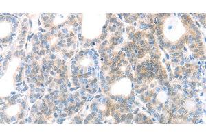 Immunohistochemistry of paraffin-embedded Human thyroid cancer using MAGED1 Polyclonal Antibody at dilution of 1:30 (MAGED1 antibody)