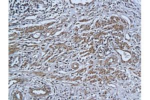 Formalin-fixed and paraffin embedded human cervical cancer labeled with Anti-ADAR1 (N-terminus) Polyclonal Antibody, Unconjugated (ABIN678218) followed by conjugation to the secondary antibody and DAB staining (ADAR antibody  (AA 151-250))
