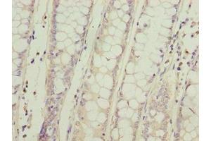 Immunohistochemistry of paraffin-embedded human colon cancer using ABIN7169615 at dilution of 1:100 (SPCS2 antibody  (AA 7-86))