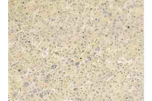 ABIN6261001 and ABIN6279253 at 1/100 staining human hepatocellular carcinoma by IHC-P.