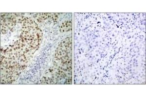 Immunohistochemistry analysis of paraffin-embedded human breast carcinoma tissue, using p53 (Ab-6) Antibody. (p53 antibody  (AA 1-50))