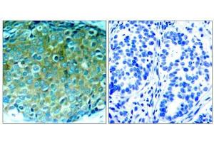 Immunohistochemical analysis of paraffin-embedded human breast carcinoma tissue, using PAK1 (Ab-212) antibody (E021160). (PAK1 antibody)