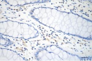 Immunohistochemistry was performed on paraffin-embedded human sigmoid colon carcinoma using COPS8 antibody (ABIN7798152), 1:200).