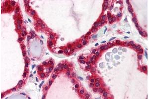 Human Thyroid (formalin-fixed, paraffin-embedded) stained with STIM1 antibody ABIN239828 at 5 ug/ml followed by biotinylated anti-mouse IgG secondary antibody ABIN481714, alkaline phosphatase-streptavidin and chromogen. (STIM1 antibody  (C-Term))