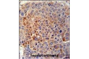 GPLD1 Antibody (C-term) (ABIN389063 and ABIN2839268) immunohistochemistry analysis in formalin fixed and paraffin embedded human hepatocarcinoma tissue followed by peroxidase conjugation of the secondary antibody and DAB staining.