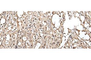 Immunohistochemistry of paraffin-embedded Human colorectal cancer tissue using UTP3 Polyclonal Antibody at dilution of 1:40(x200) (UTP3 antibody)
