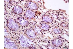 Formalin-fixed and paraffin embedded human gastric carcinoma labeled with Anti-Calponin 1/COLP Polyclonal Antibody, Unconjugated (ABIN724820) at 1:200 followed by conjugation to the secondary antibody and DAB staining