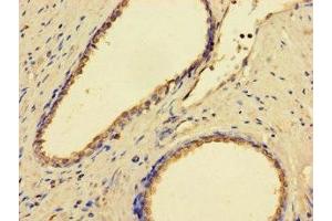 Immunohistochemistry of paraffin-embedded human prostate cancer using ABIN7158978 at dilution of 1:100 (GMPPB antibody  (AA 61-360))