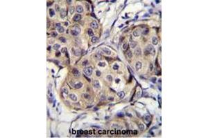 CBLN2 Antibody (C-term) immunohistochemistry analysis in formalin fixed and paraffin embedded human breast carcinoma followed by peroxidase conjugation of the secondary antibody and DAB staining. (CBLN2 antibody  (C-Term))