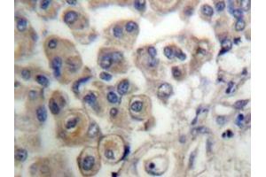 Immunohistochemistry analyzes of PLC β3 antibody in paraffin-embedded human breast carcinoma tissue. (PLCB3 antibody)